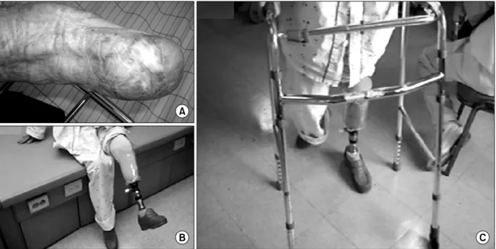 Fig. 2.  (A)  Healed  stump  site.  (B)  Application  of  prosthesis.  (C)  Gait  training  with  prosthesis.