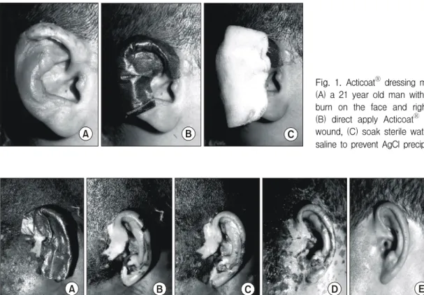 Fig.  1.  Acticoat Ⓡ  dressing  method. 