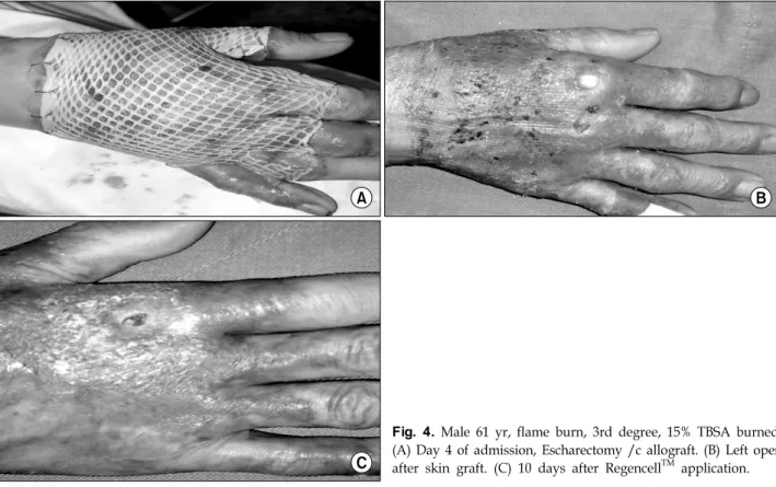 Table 1.  Characters  of  Patients  Group Sex:     Male/Female Mean  age Etiology:     Flame/Scald/Contact/Electrical Mean  TBSA  of  full  thickness  burn Mean  total  time  of  Regencell    application