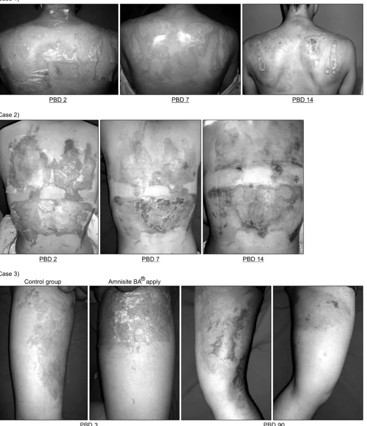 Fig. 3. Case.  PBD  =  post  burn  days.