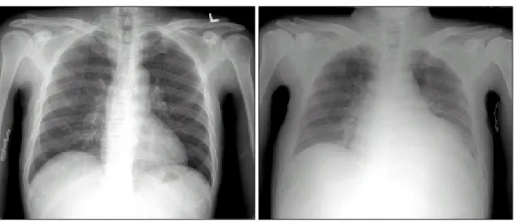 Fig.  2.  Finding  of  Aortic  vegetation  on  echocardiography.