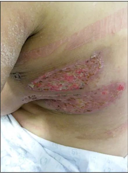 Fig. 4.  Skin  uptake  was  partially  failed  in  the  chest  wall.