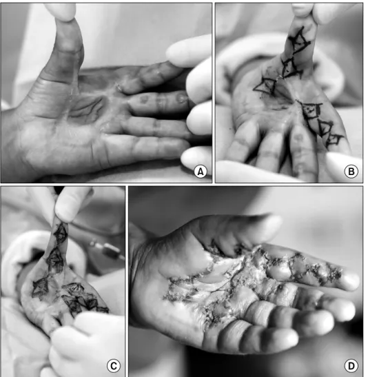 Fig. 4.  (A)  Multiple  long  linearr  contracture  bands  located  on  thumb,  index  finger  and  long  finger  respectively  with  a  wide  scar  contracture  on  palm