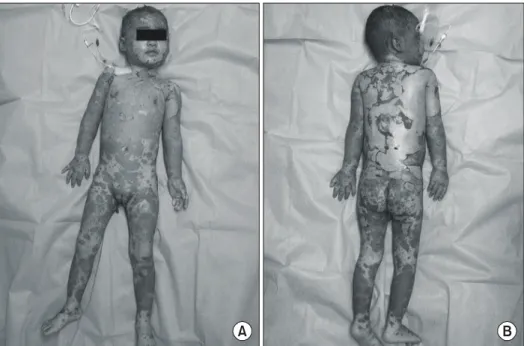 Fig. 6. Images  of  TEN  patient  2  weeks  after  managed  with   Al-levyn Ⓡ .  (A)  Anterior  view  and  (B)  posterior  view