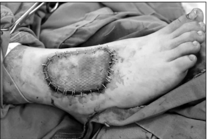 Fig. 4.  Intraoperative  view,  contracture  was  released  and  Alloderm Ⓡ   was  applied.