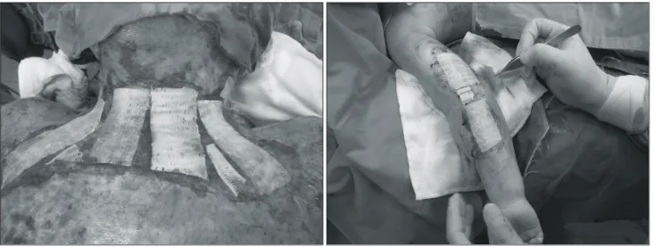 Fig. 2.  AlloDerm Ⓡ   wasn’t  fixed  separately.  AlloDerm Ⓡ s  were  always  fixed  along  with  the  skin  graft  by  small  staples.