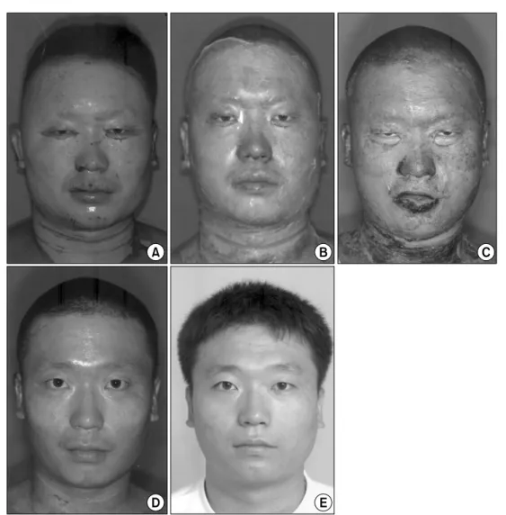 Fig.  1.  A  28-year-old  male  patient  with  superficial  second  degree  burn  on  the  face  and  deep  second  degree  burn  on  the  right  forearm,  6%  of  total  body  surface  area,  (A)  Immediate  appearance  of  the  face  with  burn  wound