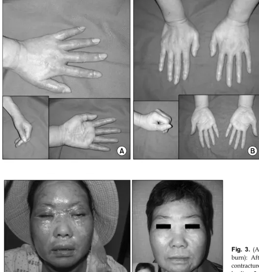 Fig. 2. (A)  Before  treatment  (date. 