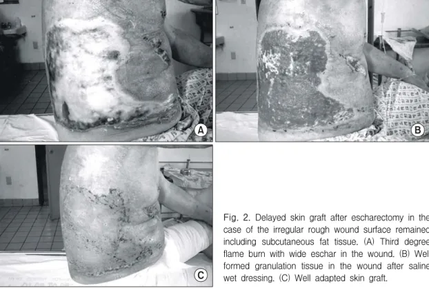 Fig.  2.  Delayed  skin  graft  after  escharectomy  in  the  case  of  the  irregular  rough  wound  surface  remained  including  subcutaneous  fat  tissue