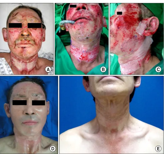 Fig. 2.  Study  group,  case  1.  A  53-year-old  male  patient  with  deep  second-degree  flame  burn  on  the  face  and  neck