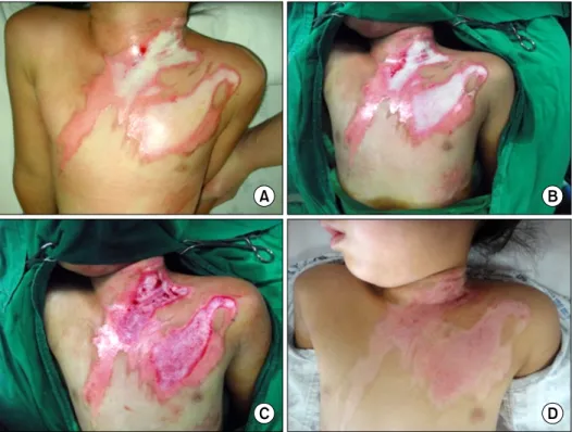 Fig. 4.  Control  group,  case.  A  9  months  female  patient  with  deep  second-degree  scalding  burn  on  forearm