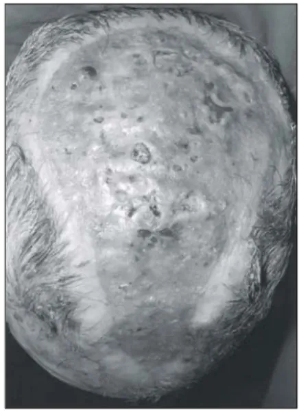 Fig.  4.  23  days  after  STSG  showing  approximately  95%  graft  take,  and  the  loss  was  mainly  in  exposed  skull.