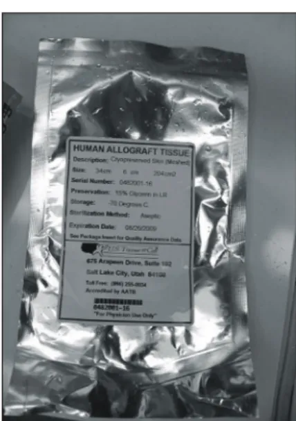 Fig.  2.  Pinpoint  bleeding  in  living  dermis  after  tan- tan-gential  excision.