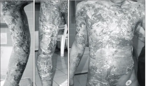 Fig.  4.  Fixation  of  cadaver  skin  by  using  staple  and  roll  gauze.