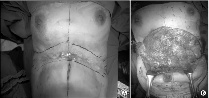 Fig. 3.  (A)  Intraoperative  design.  (B)  Wide  excision  around  contracted  burn  scar  with  Marjolin's  ulcer  and  dissection  to  lower  abdomen.