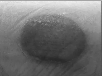 Fig. 1.  Burn  wound  4  days  after  injury  at  right  knee  as  a  shape  of  local  application  of  mustard