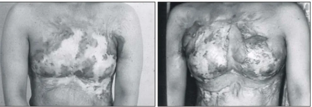 Fig.  1.  Case  of  Type  I  burned  breast.  Left,  preoperative  status.  Right,  status  of  1  year  after  operation.