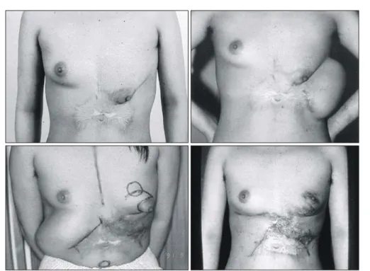 Fig.  3.  Case  of  Type  II  burned  breast.  Simple  skin  graft  was  done  for  inframammary  fold  reconstruction  and  nipple-areolar  reconstruction