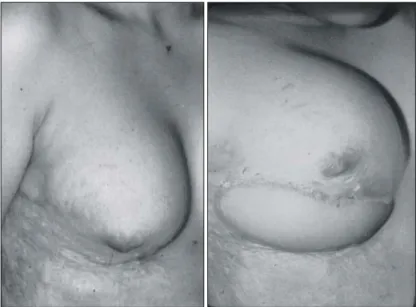 Fig.  5.  Case  of  Type  IV  burned  breast.  Areolar  skin  from  opposit  breast  were  grafted
