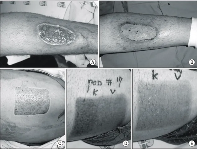 Fig.  1.  (A)  3rd  degree  contact  burn  wound  on  anterior  tibia  area  of  19  years-old  male