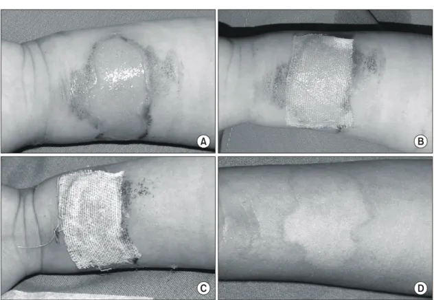 Fig.  5.  (A)  Application  of  Kaloderm Ⓡ   at  2nd  degree  flame  burn  wound  on  foot,  dorsum  of  49  years-old  male  at  PBD#  4  days