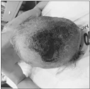 Fig. 2.  The  calvarium  was  invaded  by  4 th   degree  contact  burn.