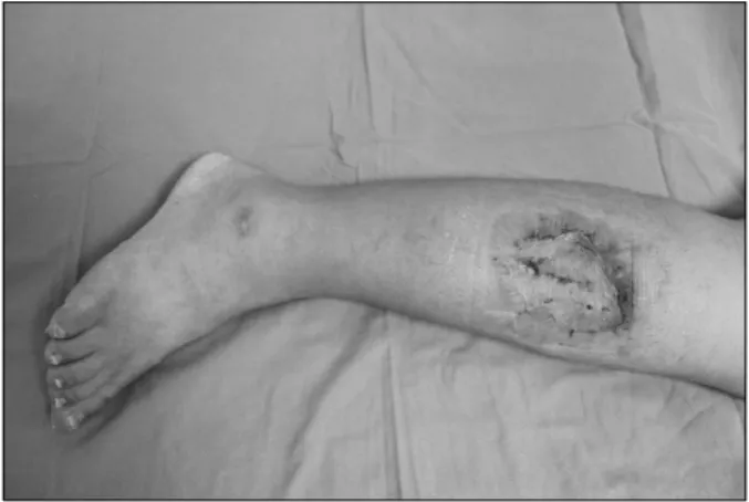 Fig. 2.  Skin  ulcer  with  purulent  discharge. Fig. 3.  Completely  healed  state  after  wide  excision  and  split  thickness  skin  graft  with  collagen-elastin  matrix  (Matriderm ® ).