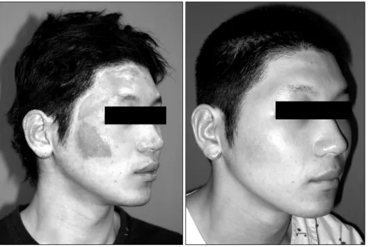 Fig. 5.  Case  2.  (Left)  42  year  old  male  presented  with  flame  burn  on  whole  face