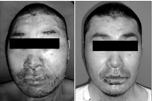Fig. 6.  Case  3.  (Left)  32  year  old  male  presented  with  scalding  burn  on  whole  face