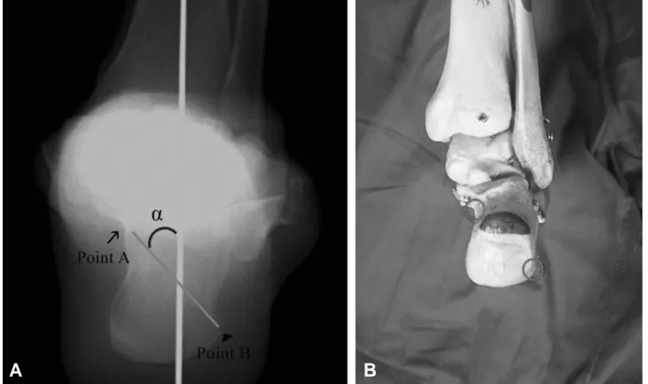 Figure 3. Method for radiographically imaging the coronal plane alignment of the hindfoot