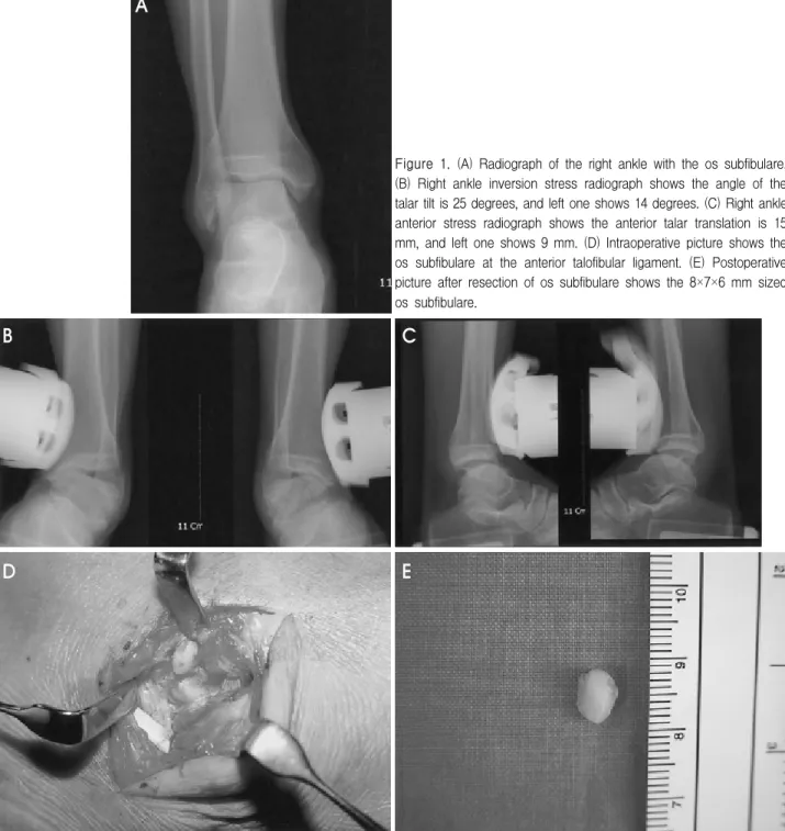 Figure 1. (A)  Radiograph  of  the  right  ankle  with  the  os  subfibulare. 