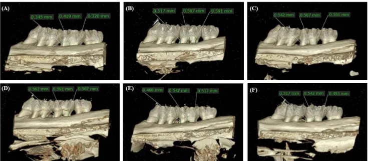 Figure  1.  3D  Micro-CT  image  of  alveolar  bone  loss  around  the  left  maxillary  molars