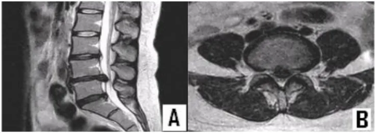 Figure 1. Sagittal(A) and axial(B) T 2  weighted MRI showing  central disc extrusion at the L 4-5 , small disc protrusion at  the L 5 -S 1  and disc degeneration at the L 3-4 , L 4-5  and L 5 -S 1 .