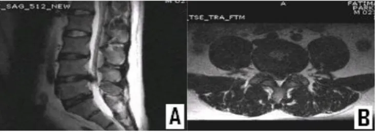 Figure 3. Sagittal(A) and axial(B) T 2  weighted MRI  showing central disc extrusion to Rt paracentral aspects at  the L 4-5  and disc degeneration at the L 3-4 , L 4-5 , L 5 -S 1 .