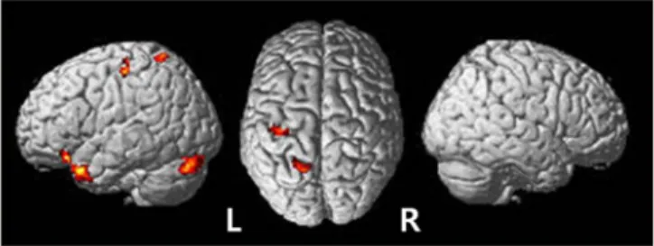 Figure 2. The average map of cortical activation  induced by transcranial direct current stimulation
