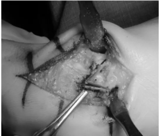Figure 1.  This  photo  demonstrates  distal  chevron  metatarsal  osteot- osteot-omy  with  excision  of  medial  wedge  to  decrease  distal  metatarsal   ar-ticular  angle