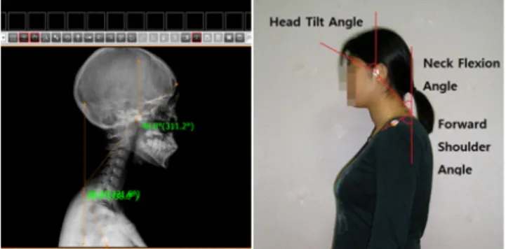 Figure 2. Measuring the HTA, NFA and FSA by using diagnostic radiation equipment (A) Diagram showing the defining lines of the joint angles of head tilt, neck flexion and acromion  displacements (B) Angles identified by three markers.