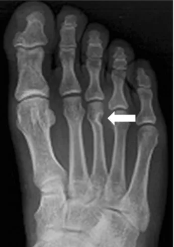 Figure 1. Anteroposterior radiograph of the right foot shows a bony indentation of the junction between the 3 rd metatarsal head and neck.