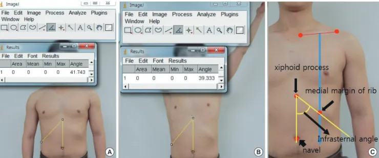 Figure 1. Measurement of infrasternal angle using image J software program. (A) In resting position, (B) In shoulder abduction 150°, (C) Landmark  of measurement.