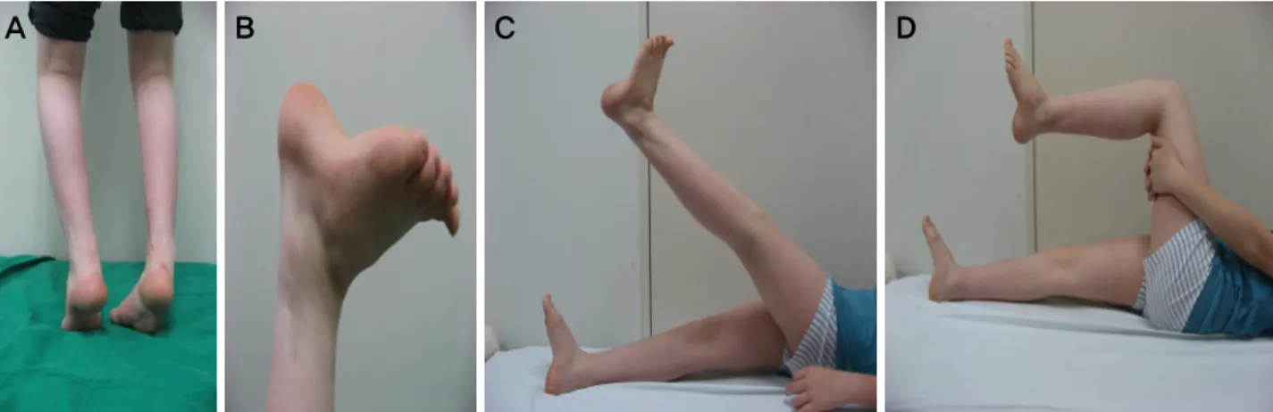 Figure  2.  The  patient  could  not  perform  double  limb  heel  rise  test  (A)  with  his  both  knees  fully  extended  position