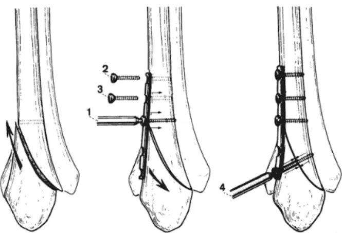 Figure  1.  A  schematic  drawing  of  the  antiglide  plate.