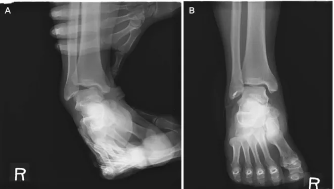 Figure  1.  (A)  Preoperative  ankle  varus  stress  test  shows  19°  talar  tilting  angle