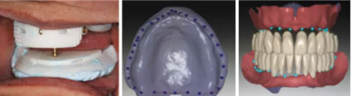 Figure  10.  Application  of  Digital  Technology  for  the  Fabri-  cation  of  Complete  Denture 
