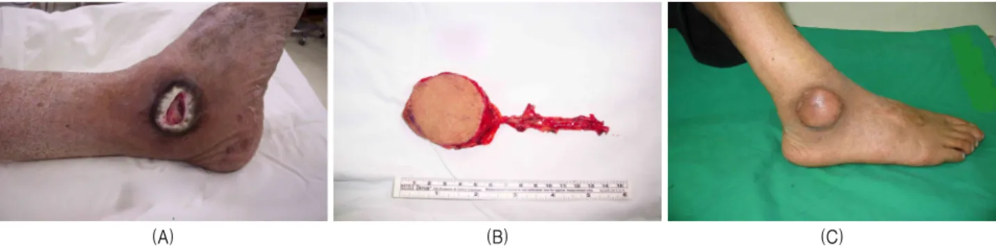 Figure  1.  A  63-year-old  man  had  a  soft  tissue  defect  of  the  lateral  aspect  on  his  ankle  (A)