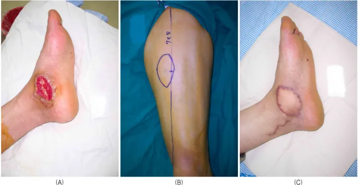 Figure  3.  A  47-year-old  man  had  a  soft  tissue  defect  of  the  medial  aspect  on  his  left  foot  (A)