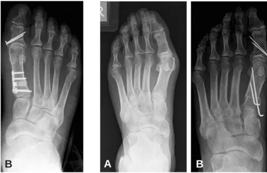 Figure 1. (A) Preoperative plain radiograph of group A (B) Final follow-up plain radiograph of group A