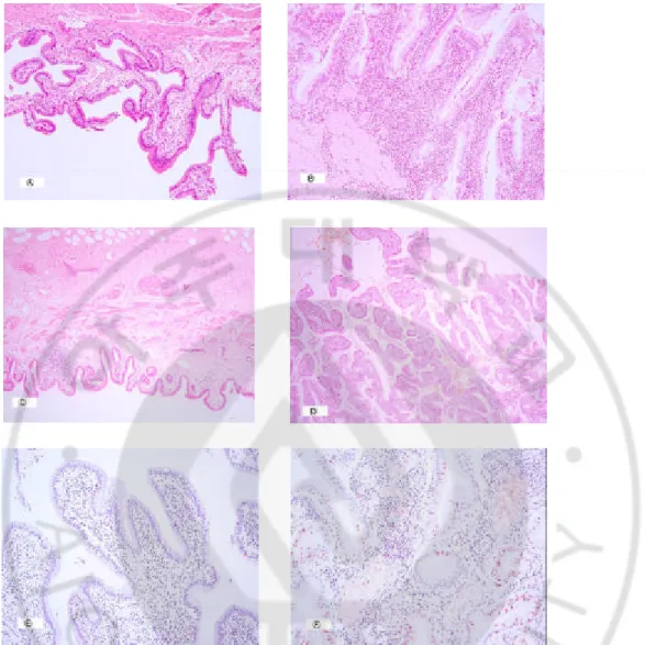 Fig 1.  Pathologic(H&amp;E stain, x40) and immunohistochemical(x200) patterns of gall            -bladder with anomalous pancreaticobiliary union