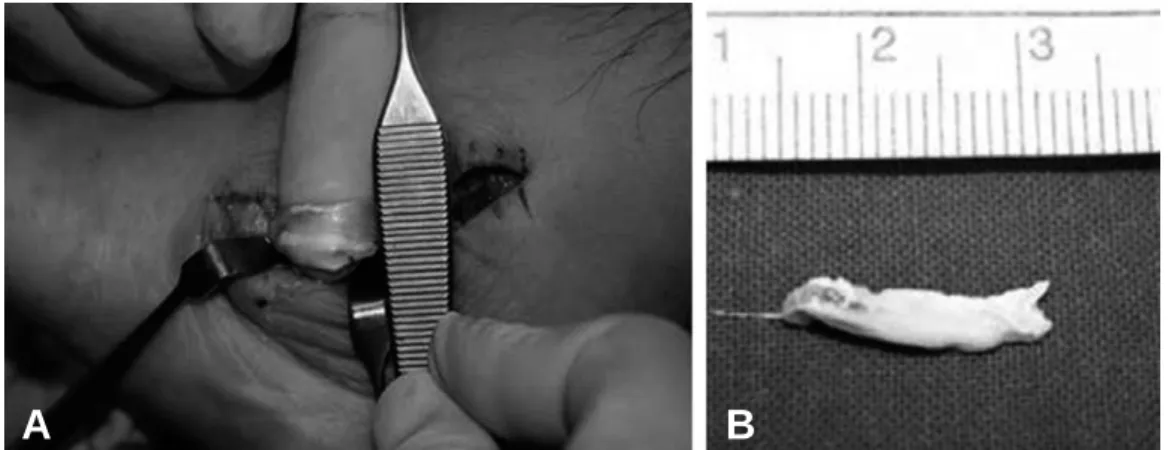 Figure 6. (A) Intraoperative view of the peroneus brevis tendon. (B) Excised some portion of peroneus brevis tendon with chalk-like deposits.