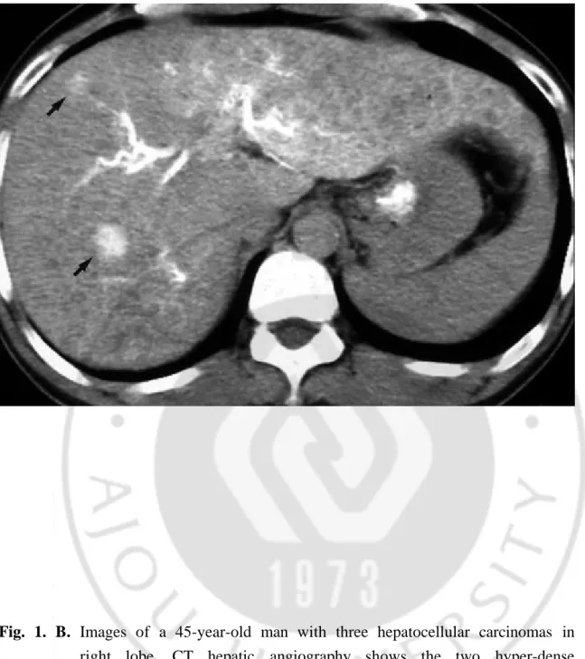 Fig.  1.  B.  Images  of  a  45-year-old  man  with  three  hepatocellular  carcinomas  in 