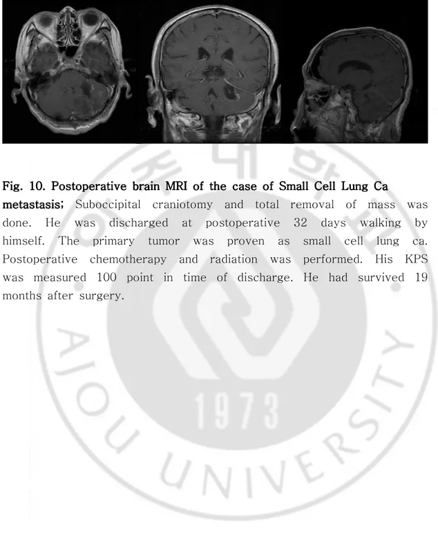 Fig.  10.  10.  10.  Postoperative  10.  Postoperative  Postoperative  Postoperative  brain  brain  brain  MRI  brain  MRI  MRI  MRI  of  of  of  the  of  the  case  the  the  case  case  case  of  of  of  of  Small  Small  Cell  Small  Small  Cell  Cell  